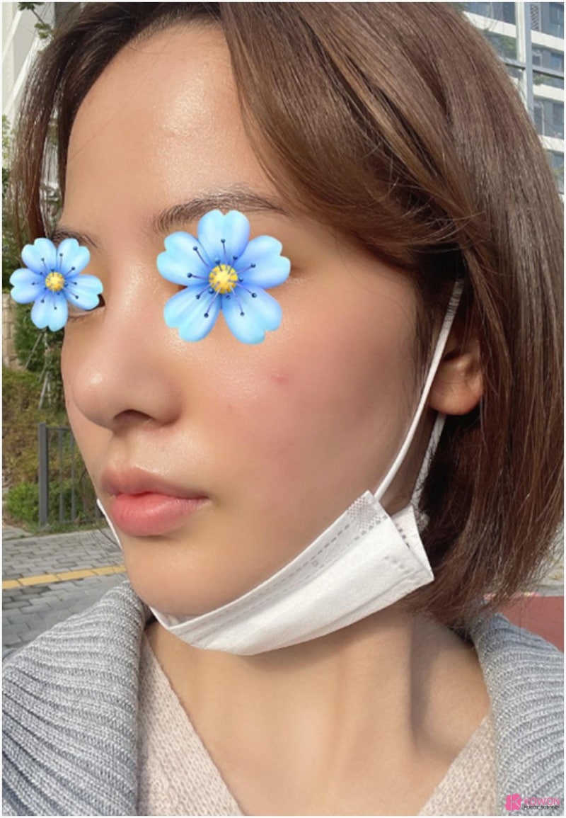 복코성형외과 콧대실리콘 이용한 방법 사진 9