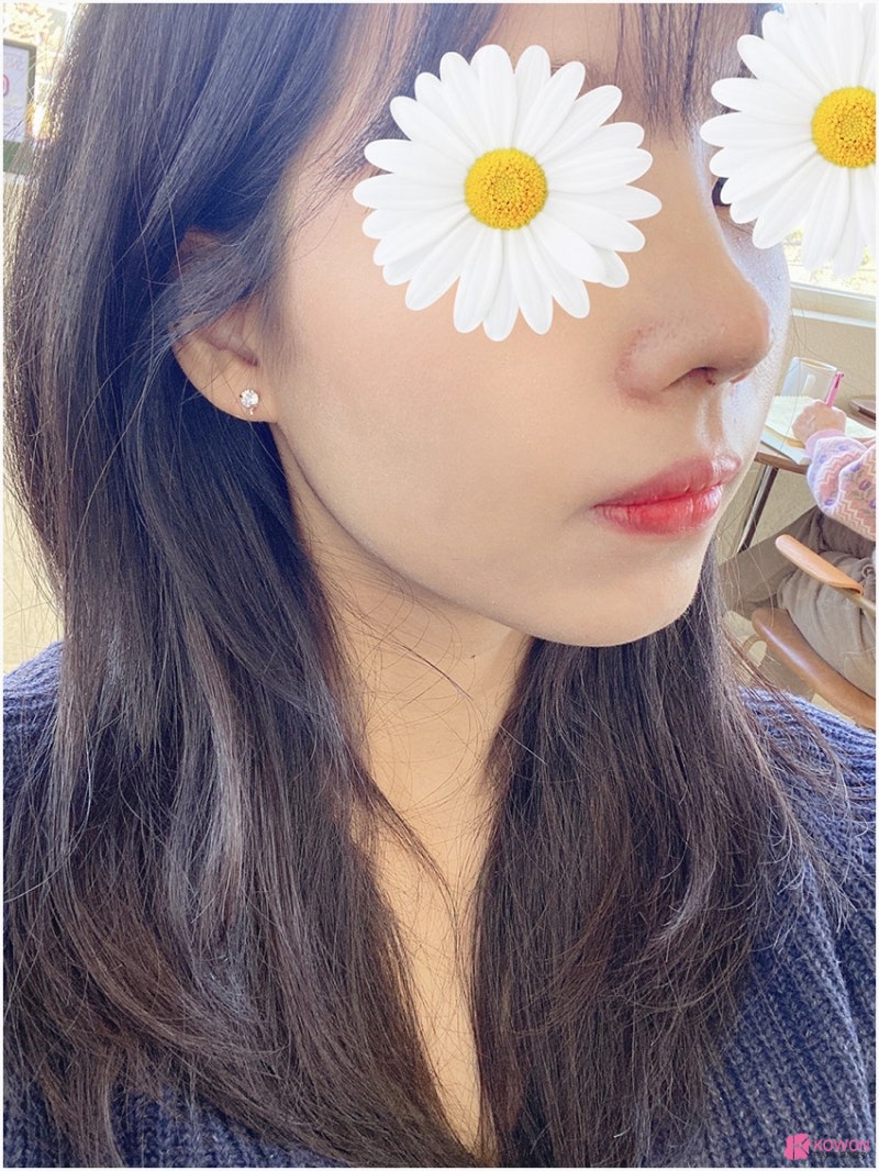 여자매부리코 수술 후 변화 콧등튀어나옴 해결 사진 10