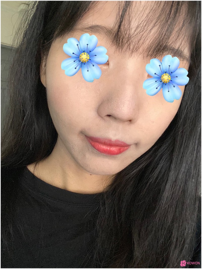 여자매부리코 수술 후 변화 콧등튀어나옴 해결 사진 7