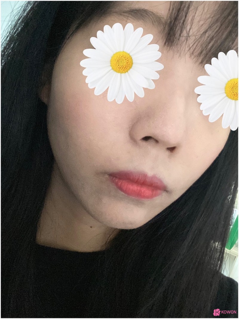 여자매부리코 수술 후 변화 콧등튀어나옴 해결 사진 3