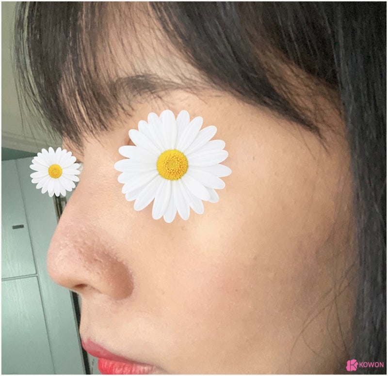 여자매부리코 수술 후 변화 콧등튀어나옴 해결 사진 5