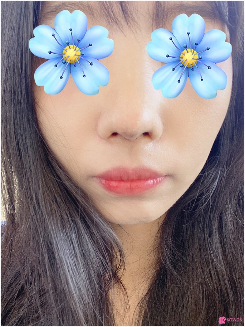 여자매부리코 수술 후 변화 콧등튀어나옴 해결 사진 8