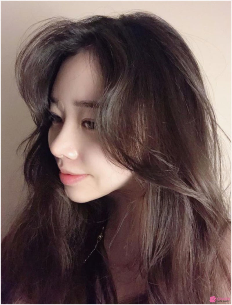 귀연골코수술 통해 작고낮은코 고민 해결 사진 4