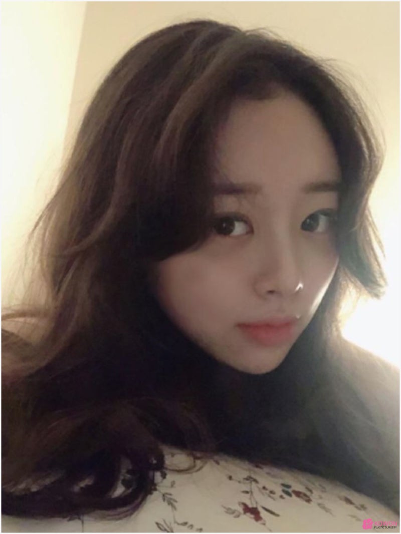 귀연골코수술 통해 작고낮은코 고민 해결 사진 5