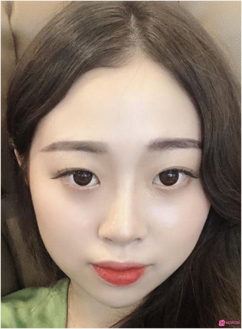 귀연골코수술 통해 작고낮은코 고민 해결 사진 3