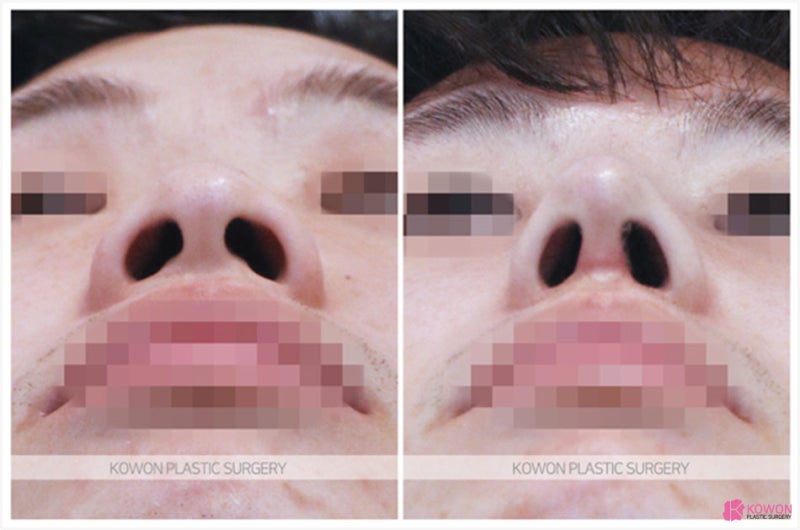 복코재수술 사례 코수술성형외과 콤플렉스 해결