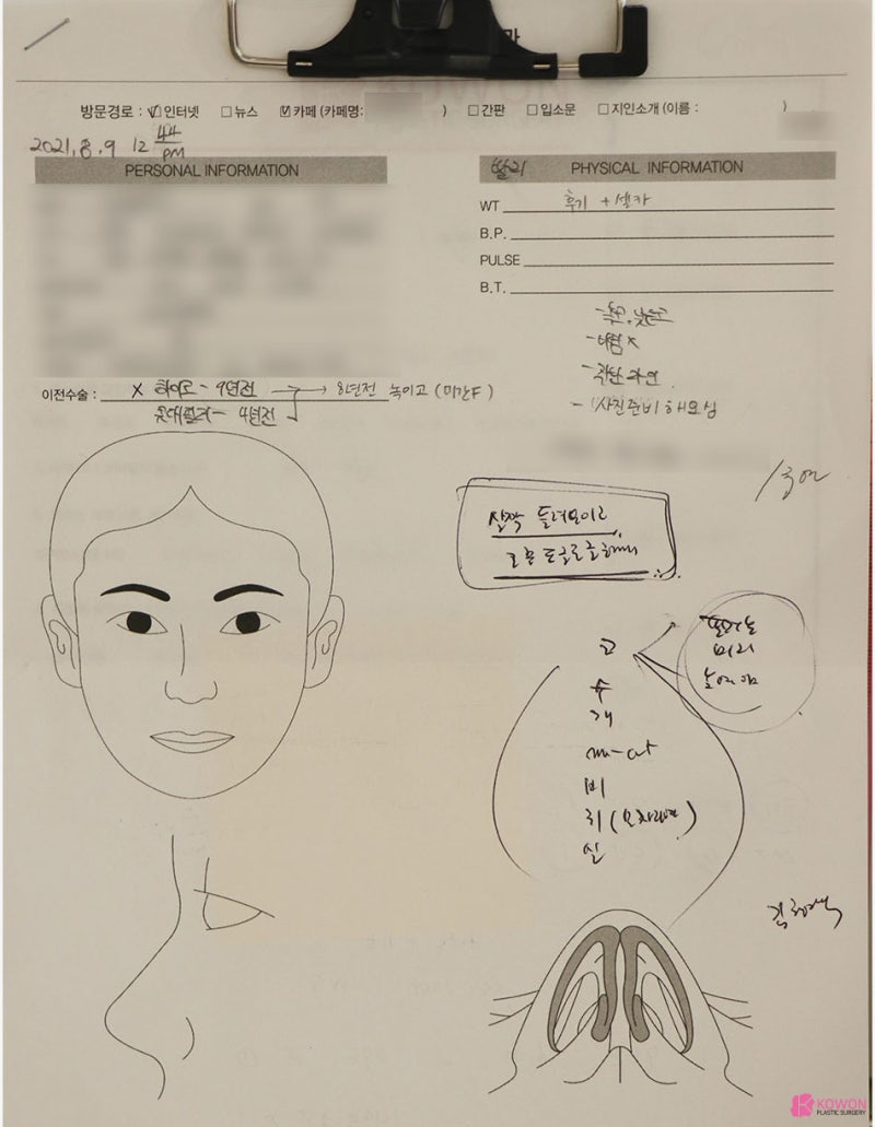 코필러성형외과 결혼식 전 높은콧대