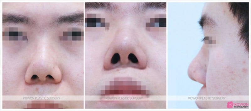 코늘리기 통한 이미지 변화 코비대칭수술