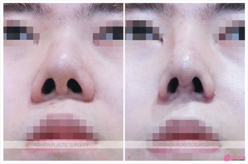 코늘리기 통한 이미지 변화 코비대칭수술 사진 6