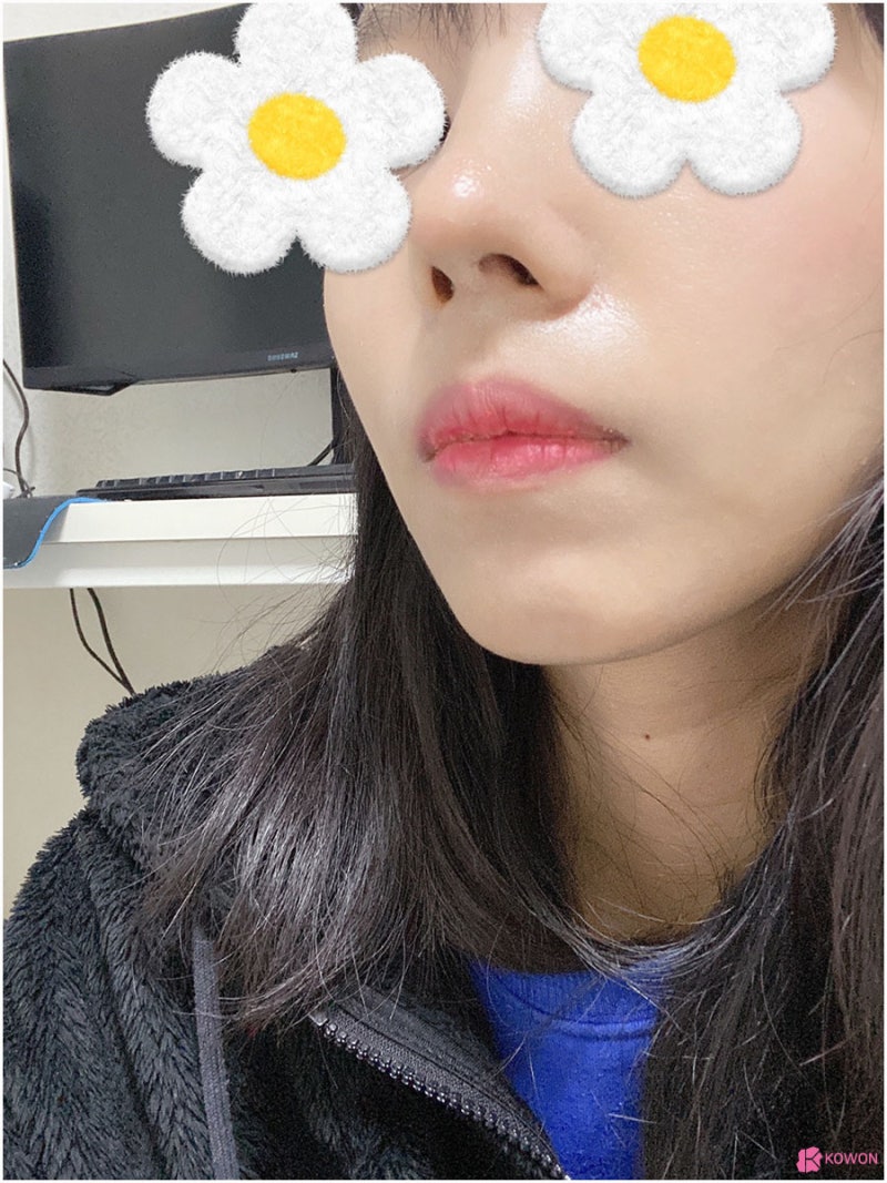 강남성형외과추천 사나운인상 개선하려면 사진 11