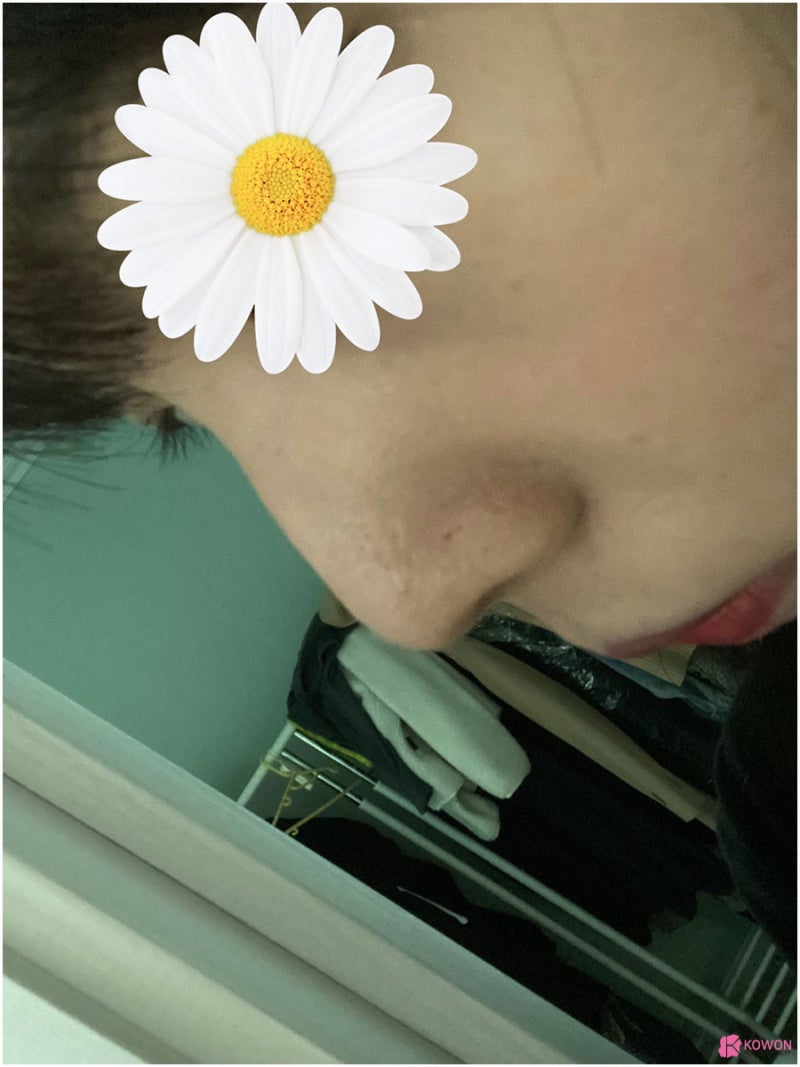 청담성형외과 자가연골코수술 진행 사례 사진 3