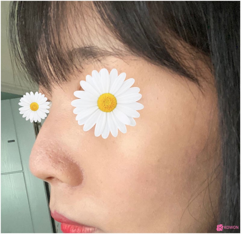 청담성형외과 자가연골코수술 진행 사례 사진 4