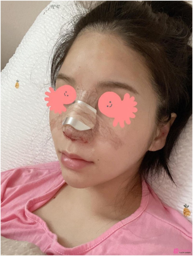 코재성형 고민 중이라면 콧대높이는수술 사진 6