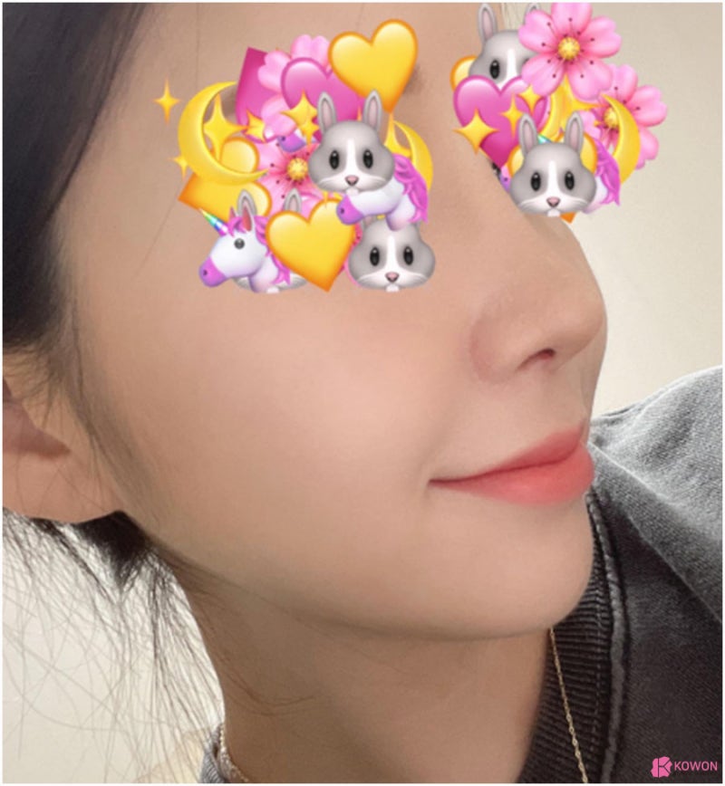 코재성형 고민 중이라면 콧대높이는수술 사진 9