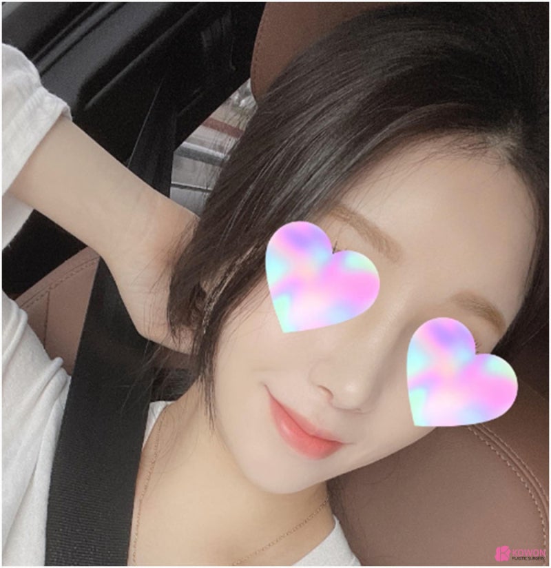 코재성형 고민 중이라면 콧대높이는수술 사진 8