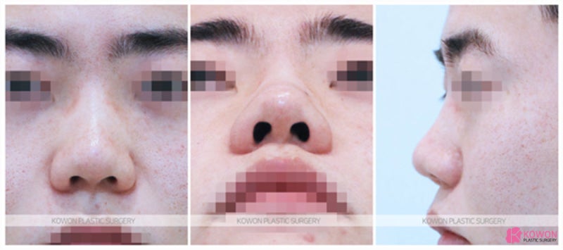 코성형전문의 유명한곳 남자복코 해결하기 사진 2