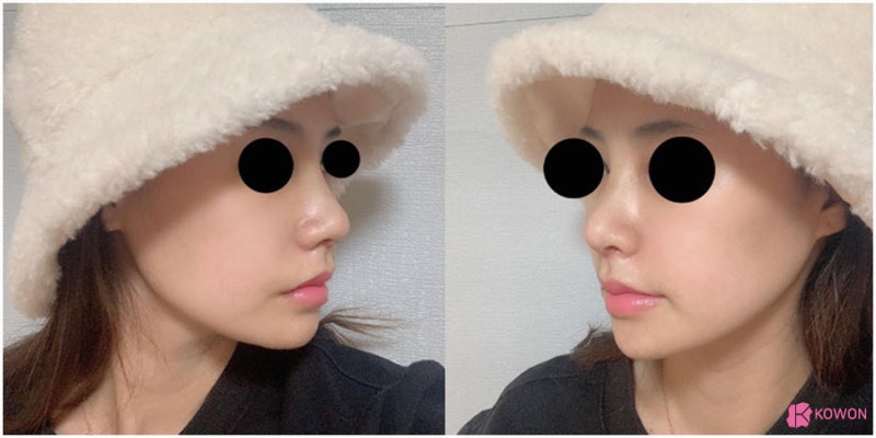 신사코성형 잘하는 곳 세련된 직반버선코후기 사진 8