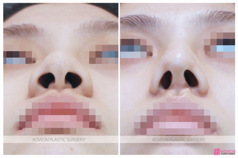 콧볼줄이기 전후 비교 코성형전문성형외과