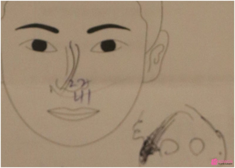 콧볼줄이기 전후 비교 코성형전문성형외과 사진 5