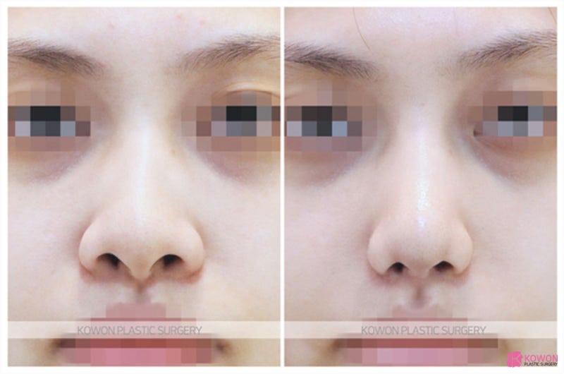 콧볼줄이기 전후 비교 코성형전문성형외과 사진 8