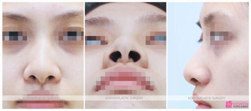 콧볼줄이기 전후 비교 코성형전문성형외과 사진 2