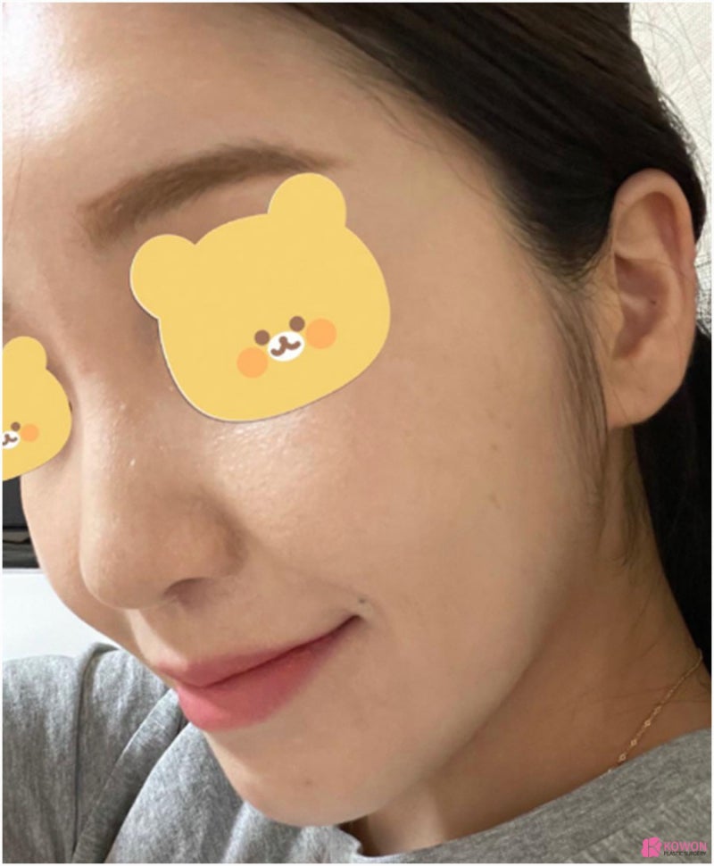 세련된코 원한다면 압구정성형외과추천 사진 3