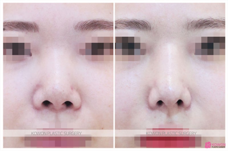 매부리코성형부작용 강남코재수술잘하는곳 사진 5