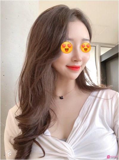 낮은코수술 사례 코성형외과추천 사진 3