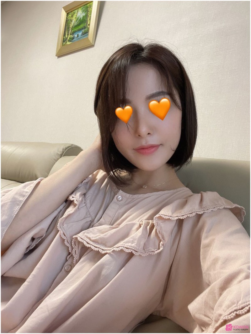 높은코 자연스러운 코성형3개월 변화 비교 사진 12