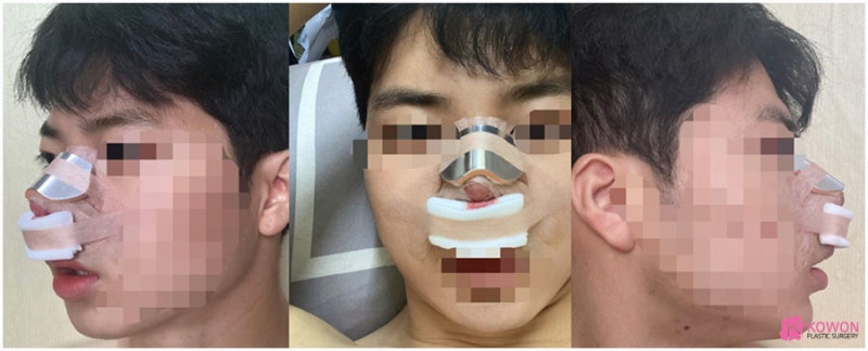 복코개선 남성 환자 통통한코 고민이라면 사진 3
