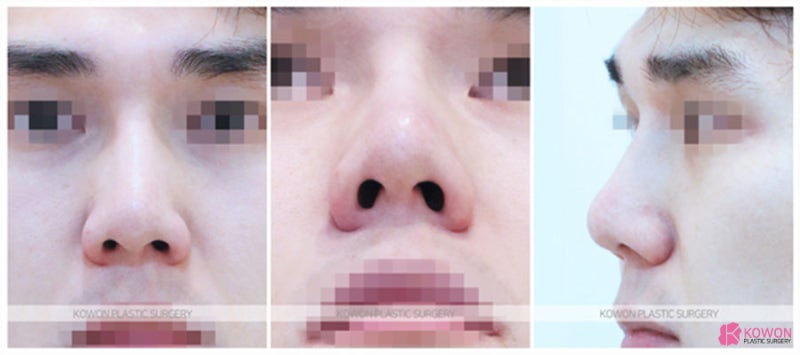 코재수술잘하는병원 남자 낮은코성형 후기 사진 3