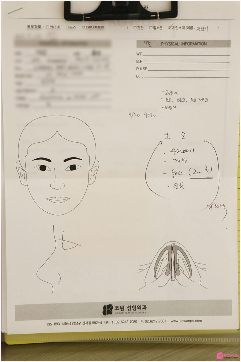 코끝수술후기 전후 비교 신사성형외과