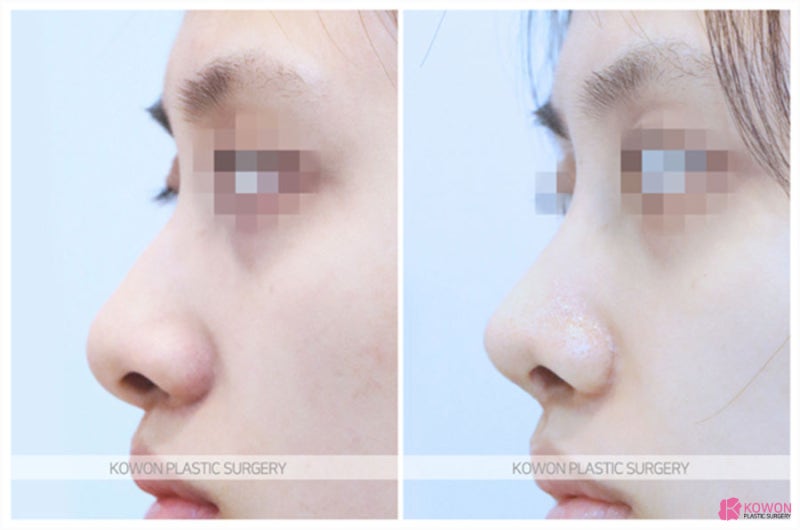 코끝연골묶기수술 역삼동성형외과 찾는다면 사진 6