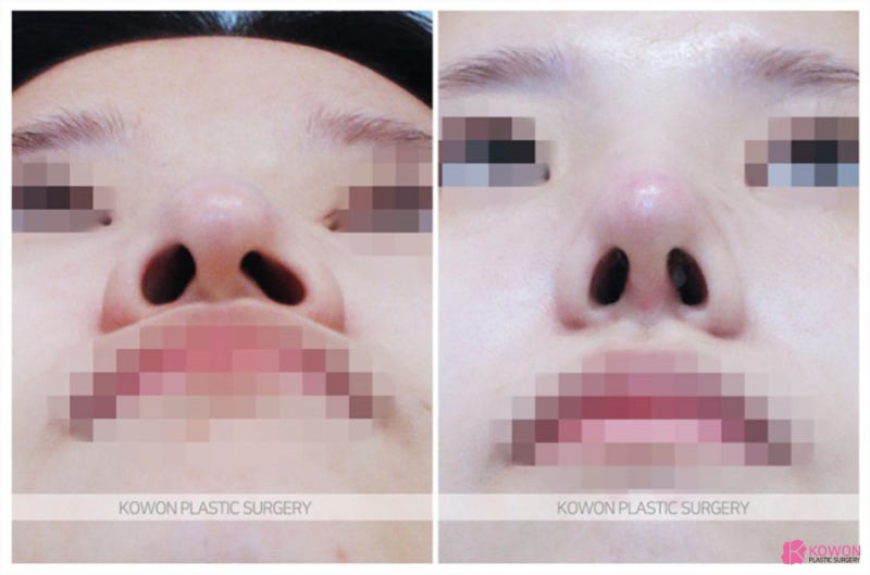 코수술성형외과 긴코성형 통한 이미지 변화 사진 7