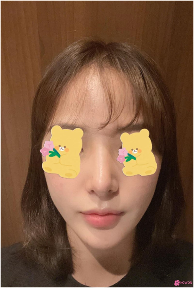 코필러후수술 여성 환자 후기 압구정역성형외과 사진 7