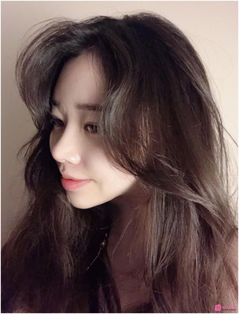 작은코수술 통한 이미지 변화 압구정동성형외과 사진 4