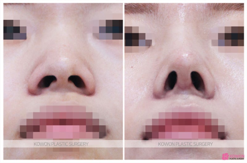 낮은코수술후기 공유 강남코전문성형외과 사진 7