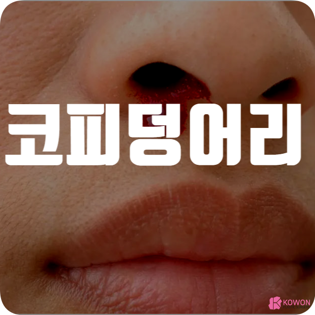 코피 덩어리 생겼다면 증상 발생 원인 및 대처
