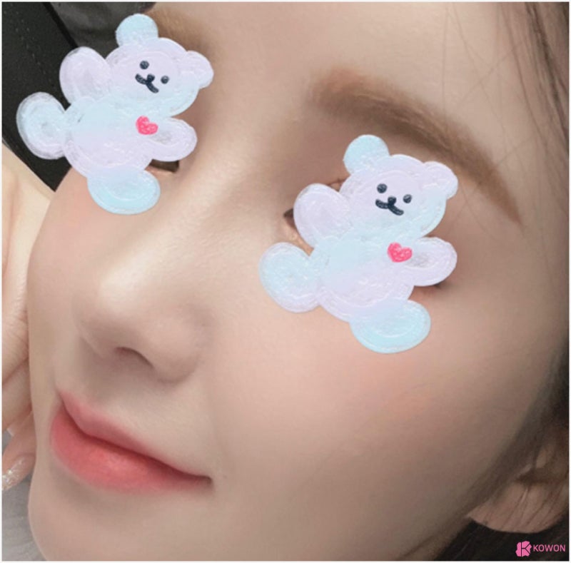 비중격휨 모양 기능 개선 논현동성형외과 사진 7