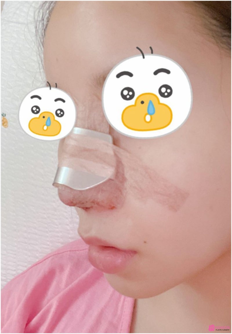 복코성형전후 이미지 비교 코성형한달 후기 사진 5