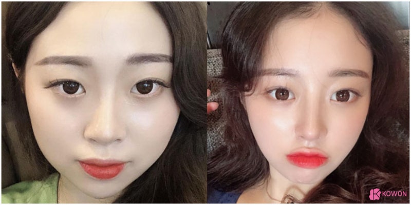 낮은코성형수술 이미지 변화 신논현성형외과