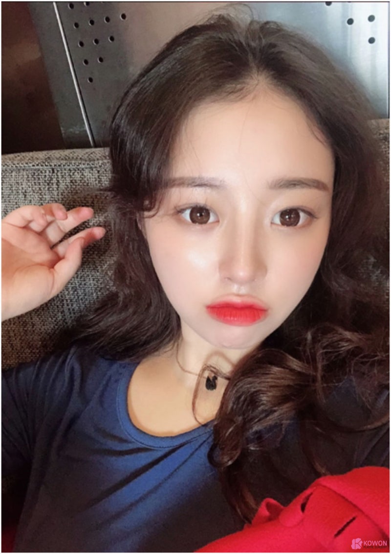 낮은코성형수술 이미지 변화 신논현성형외과 사진 8