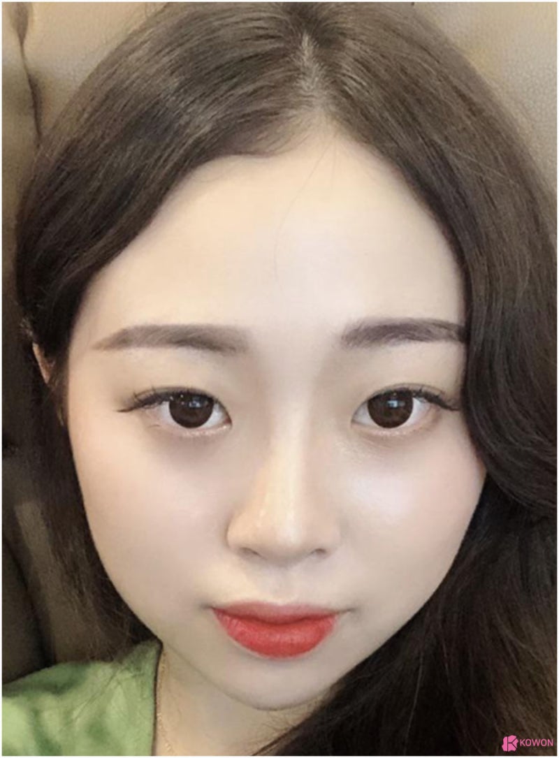 낮은코성형수술 이미지 변화 신논현성형외과 사진 3