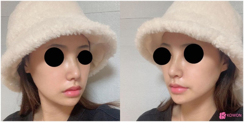 직반버선코 모양으로 변화 코잘하는성형외과 사진 9