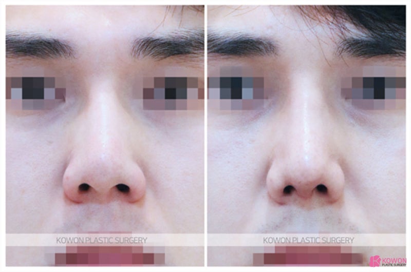 코재수술잘하는성형외과 남성 환자 낮은코성형후기 사진 7
