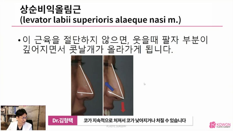 화살코교정 방법 코근육 문제 개선 통해 사진 6