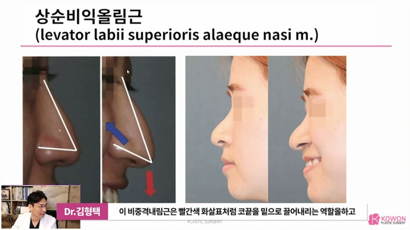 화살코교정 방법 코근육 문제 개선 통해 사진 4