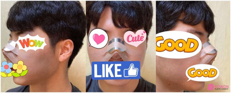 남자복코 콤플렉스 해결 서울강남성형외과 사진 4