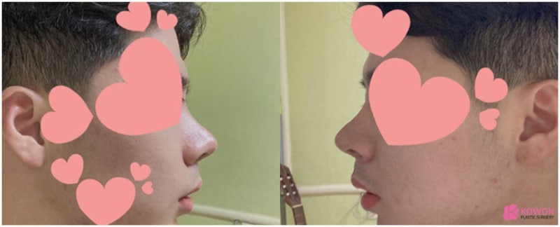 남자복코 콤플렉스 해결 서울강남성형외과 사진 6