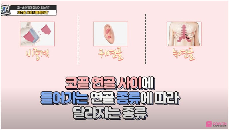 코성형외과추천 받는 곳 코수술연골 이용하여 사진 6